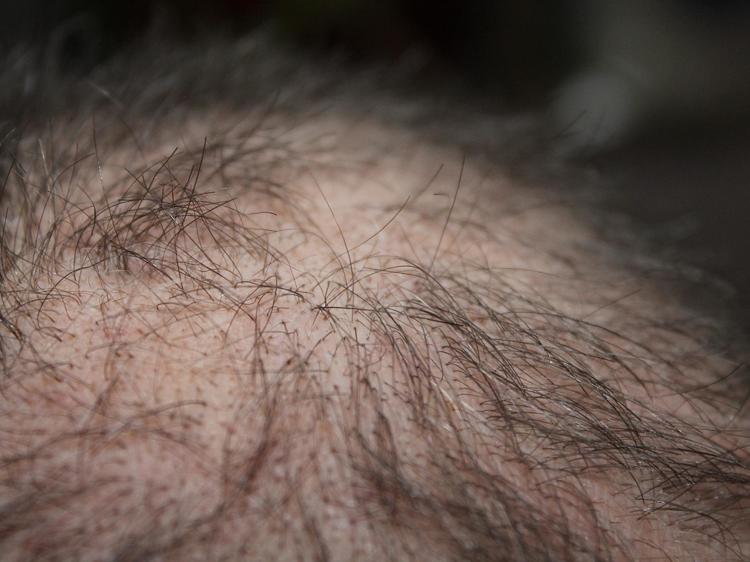 男性秃顶真的是体内雄性激素过高导致的吗？